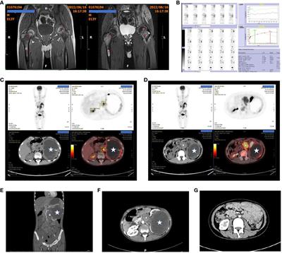 Desmoplastic small round cell tumor of the kidney: a case report and discussion